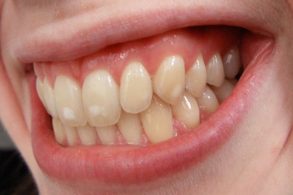 Cómo eliminar las manchas blancas de los dientes