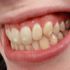 Cómo eliminar las manchas blancas de los dientes