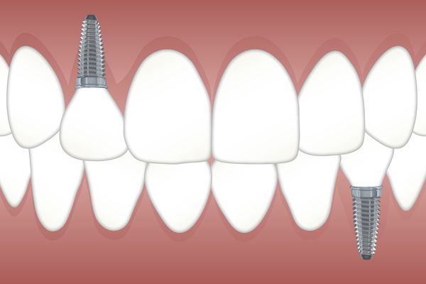 Implantes baratos versus calidad ¿Que eliges?