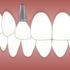 Implantes baratos versus calidad ¿Que eliges?