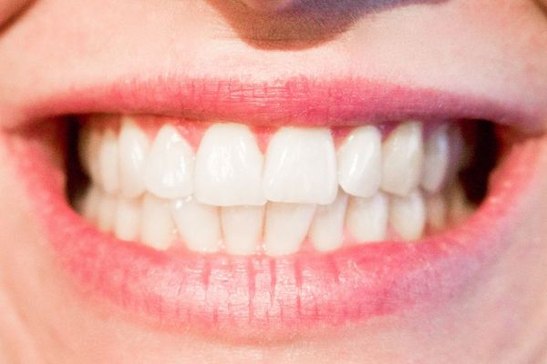 Descubre las 9 ventajas de ponerse implantes dentales