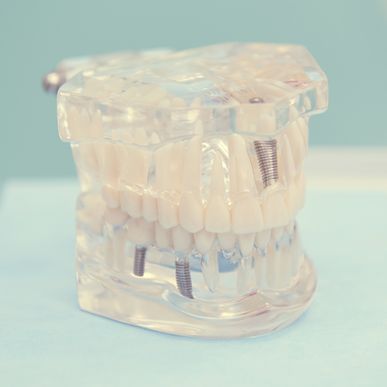 implantes dentales villalba