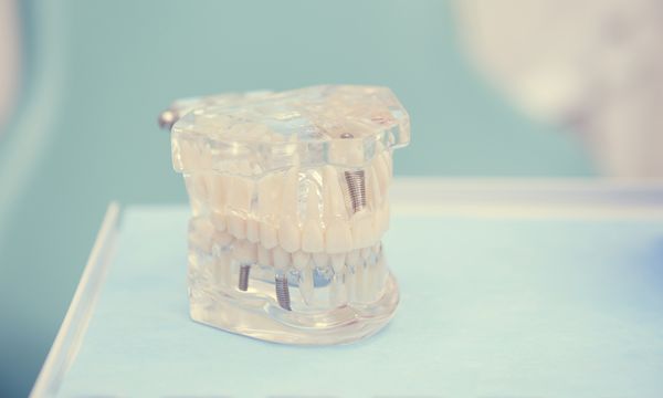 mejores implantes dentales Collado Villalba